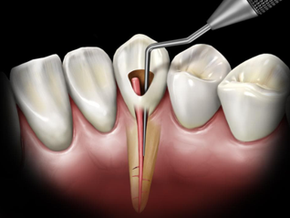 Ankara Kanal Tedavisi